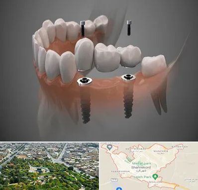 ایمپلنت دیجیتال در شهرکرد