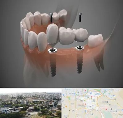 ایمپلنت دیجیتال در منطقه 20 تهران