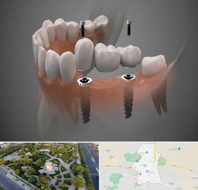 ایمپلنت دیجیتال در کاشمر