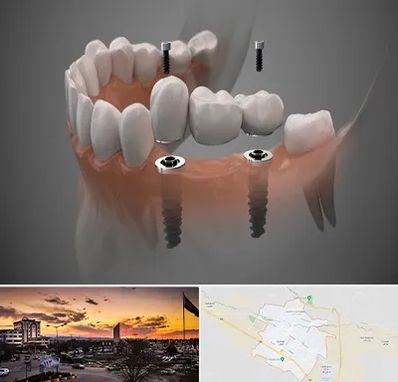 ایمپلنت دیجیتال در قوچان