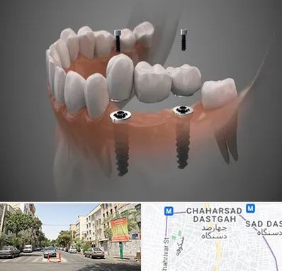 ایمپلنت دیجیتال در چهارصد دستگاه 