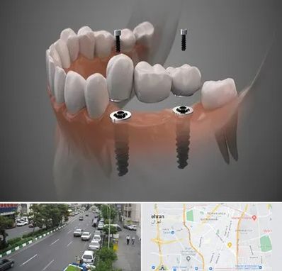 ایمپلنت دیجیتال در ستارخان 