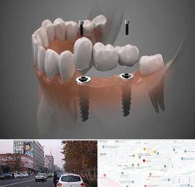 ایمپلنت دیجیتال در کارگر شمالی