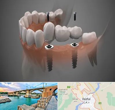 ایمپلنت دیجیتال در دزفول