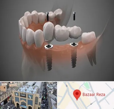ایمپلنت دیجیتال در بازار رضا مشهد