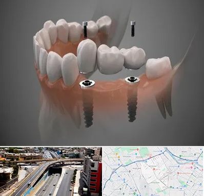 ایمپلنت دیجیتال در ستارخان شیراز