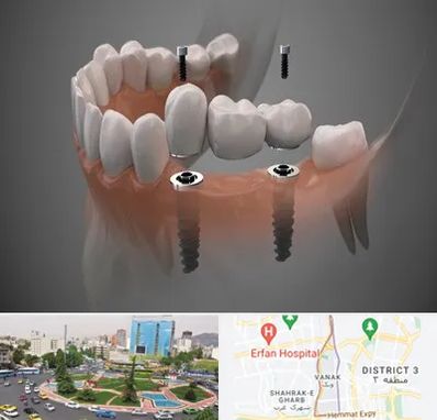 ایمپلنت دیجیتال در ونک 