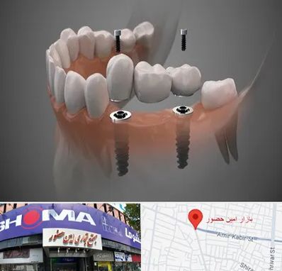 ایمپلنت دیجیتال در امین حضور