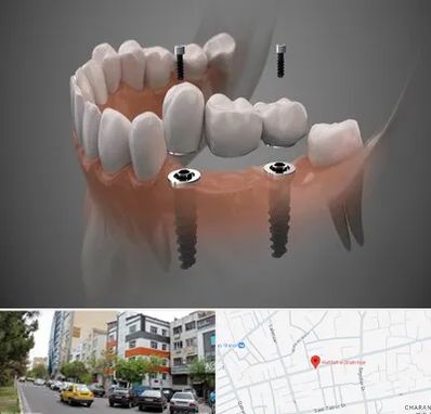 ایمپلنت دیجیتال در هفده شهریور تبریز