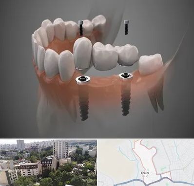 ایمپلنت دیجیتال در اوین