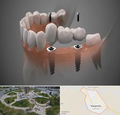 ایمپلنت دیجیتال در ورامین