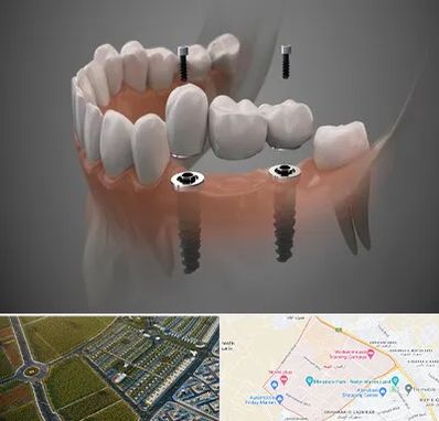 ایمپلنت دیجیتال در الهیه مشهد