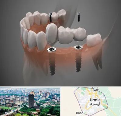 ایمپلنت دیجیتال در ارومیه