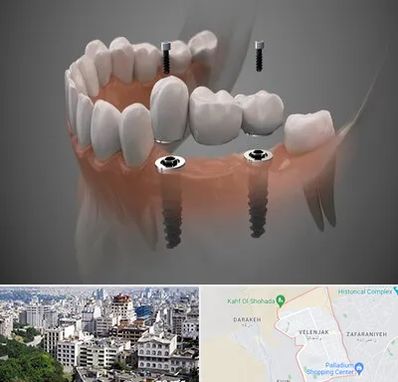 ایمپلنت دیجیتال در ولنجک 