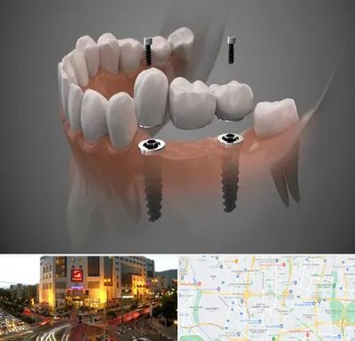 ایمپلنت دیجیتال در جنت آباد تهران 