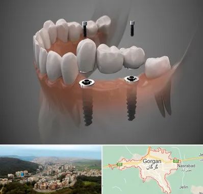 ایمپلنت دیجیتال در گرگان