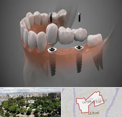 ایمپلنت دیجیتال در نیروی هوایی