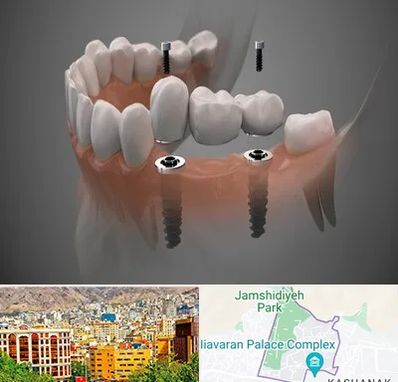 ایمپلنت دیجیتال در نیاوران 