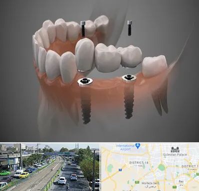 ایمپلنت دیجیتال در جنوب تهران 