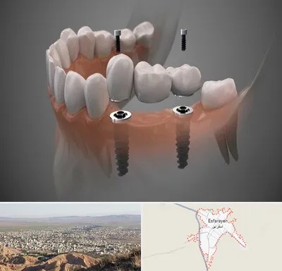ایمپلنت دیجیتال در اسفراین