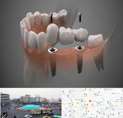 ایمپلنت دیجیتال در میدان انقلاب