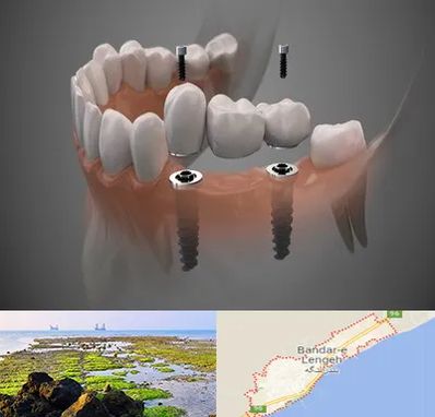 ایمپلنت دیجیتال در بندرلنگه