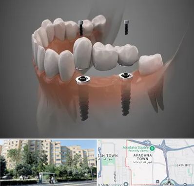 ایمپلنت دیجیتال در آپادانا