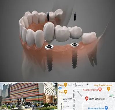 ایمپلنت دیجیتال در سهروردی 