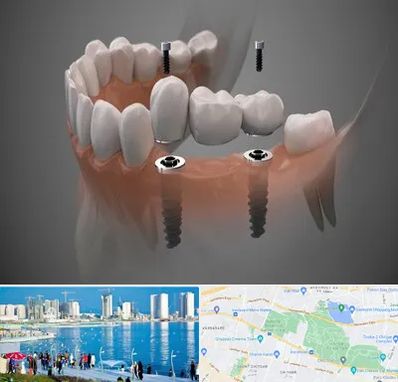 ایمپلنت دیجیتال در چیتگر 