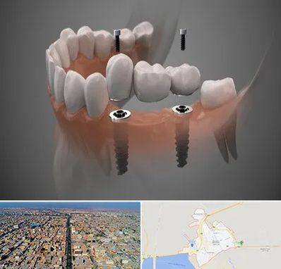 ایمپلنت دیجیتال در بندر ماهشهر