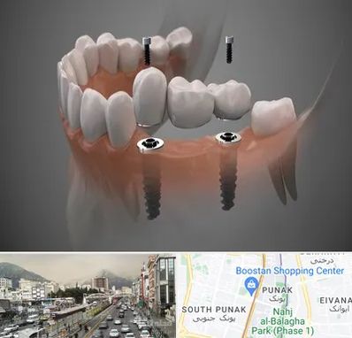 ایمپلنت دیجیتال در پونک 