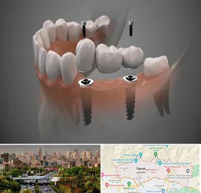 ایمپلنت دیجیتال در منطقه 1 تهران