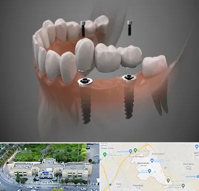 ایمپلنت دیجیتال در نسیم شهر