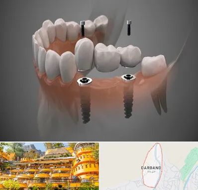 ایمپلنت دیجیتال در دربند