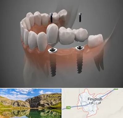 ایمپلنت دیجیتال در فیروزکوه