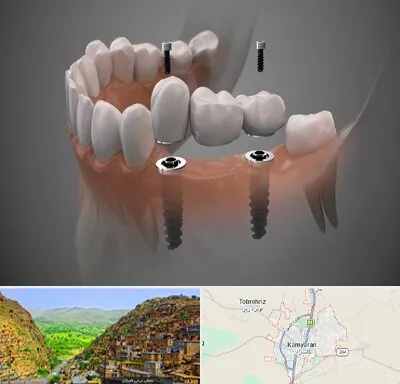 ایمپلنت دیجیتال در کامیاران