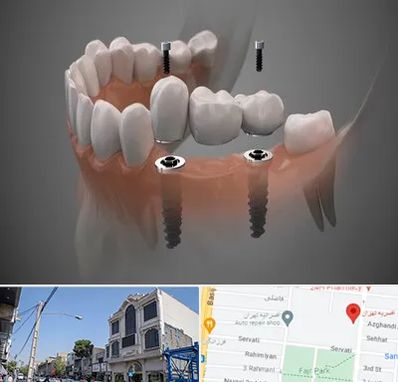 ایمپلنت دیجیتال در افسریه 