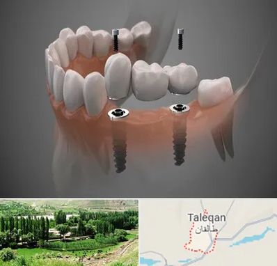 ایمپلنت دیجیتال در طالقان