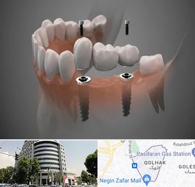 ایمپلنت دیجیتال در قلهک 