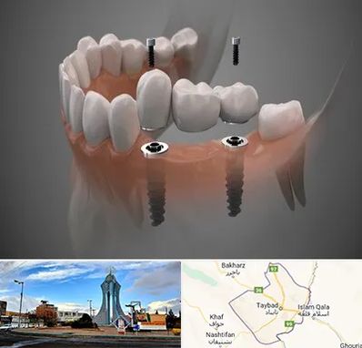ایمپلنت دیجیتال در تایباد