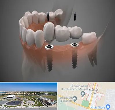 ایمپلنت دیجیتال در ملارد