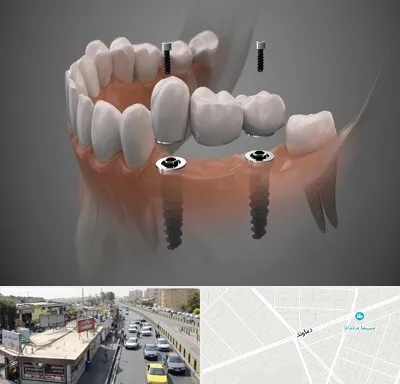 ایمپلنت دیجیتال در خیابان دماوند
