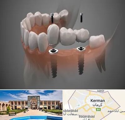 ایمپلنت دیجیتال در کرمان