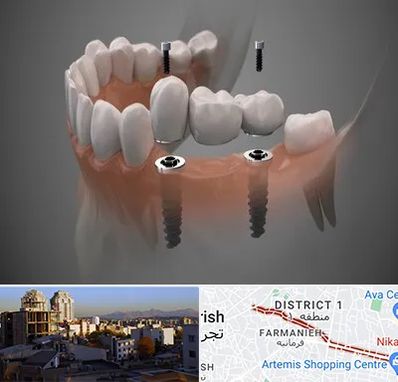 ایمپلنت دیجیتال در فرمانیه 
