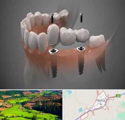 ایمپلنت دیجیتال در نکا