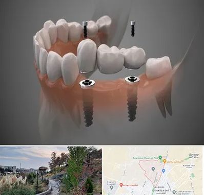 ایمپلنت دیجیتال در باغستان کرج