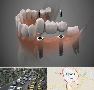 ایمپلنت دیجیتال در شهر قدس