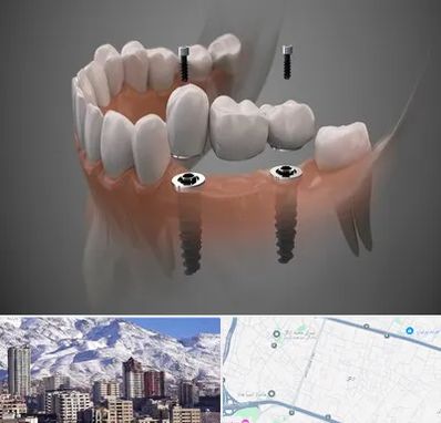 ایمپلنت دیجیتال در ازگل