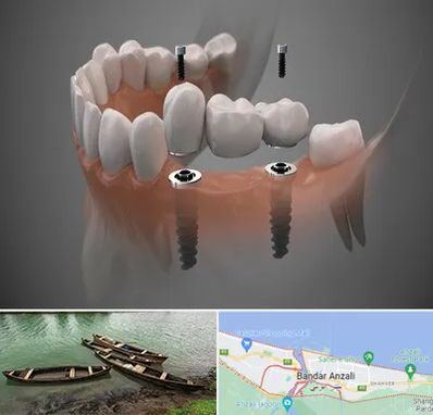 ایمپلنت دیجیتال در بندر انزلی