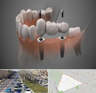 ایمپلنت دیجیتال در احمدآباد مشهد